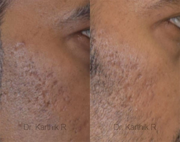 chemical peels microdermabrasion before and after photo by chennai plastic surgery in india