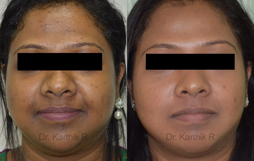 chemical peels microdermabrasion before and after photo by chennai plastic surgery in india