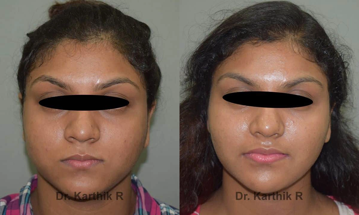chemical peels microdermabrasion before and after photo by chennai plastic surgery in india
