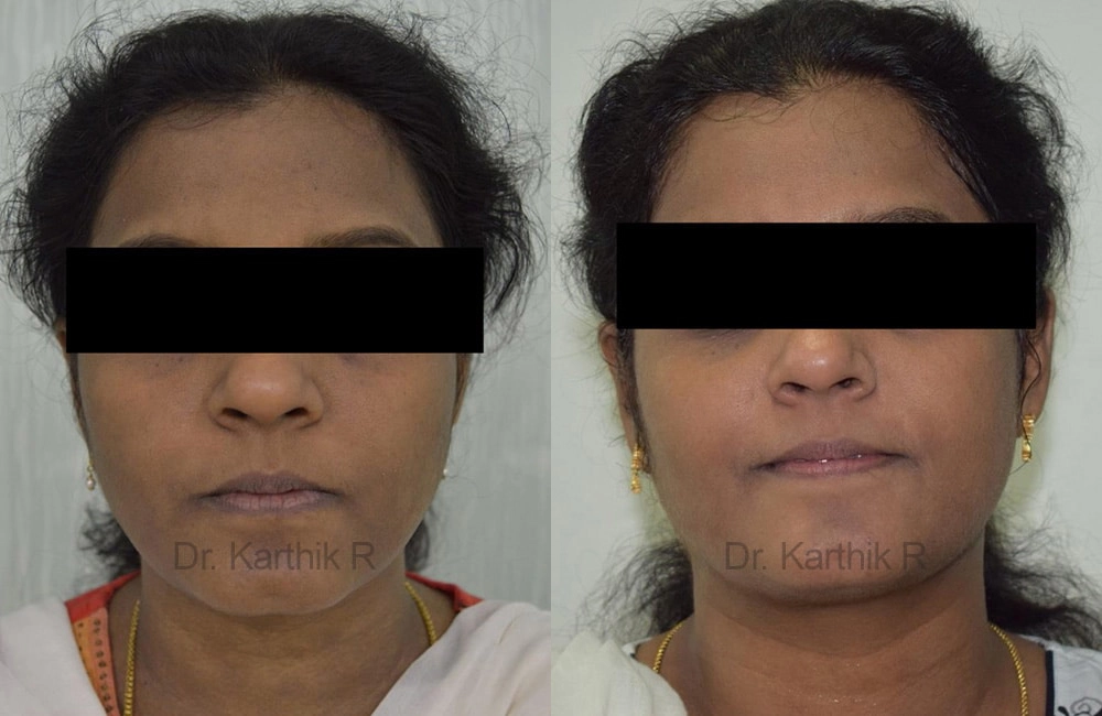 chemical peels microdermabrasion before and after photo by chennai plastic surgery in india