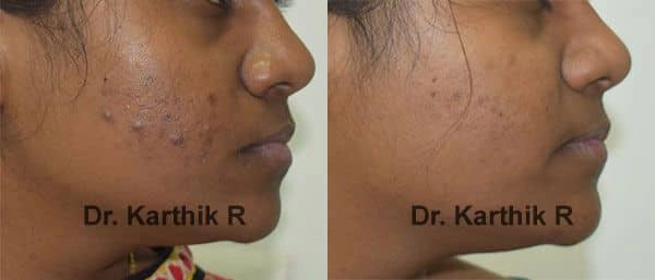 chemical peels microdermabrasion before and after photo by chennai plastic surgery in india
