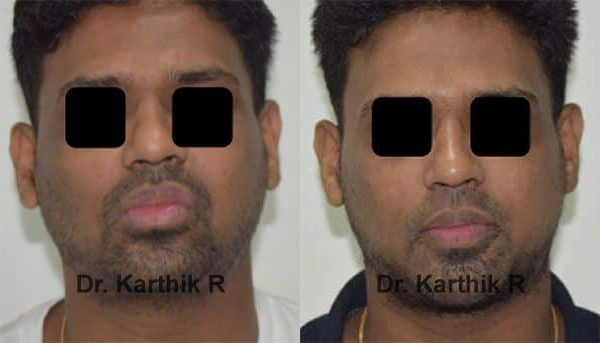 chemical peels microdermabrasion before and after photo by chennai plastic surgery in india