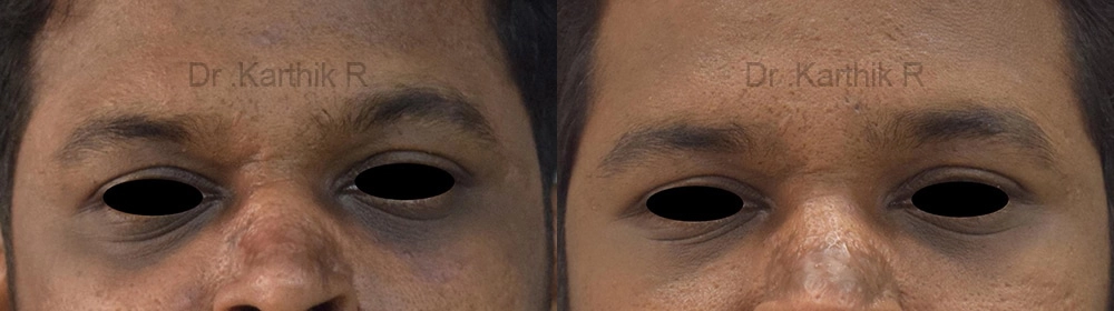 chemical peels microdermabrasion before and after photo by chennai plastic surgery in india