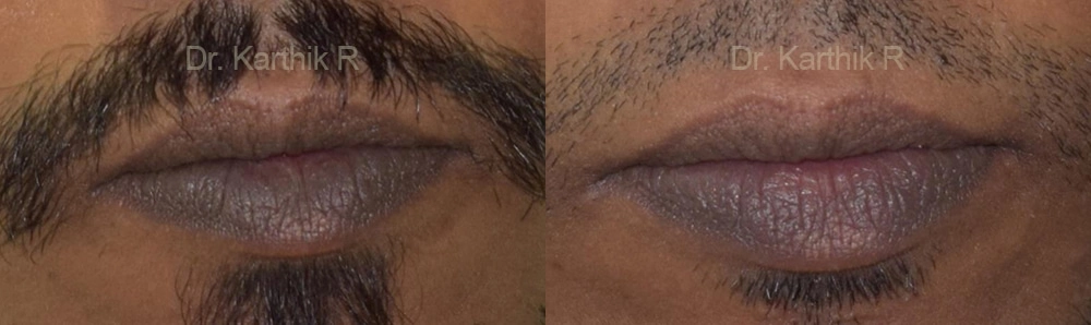 chemical peels microdermabrasion before and after photo by chennai plastic surgery in india
