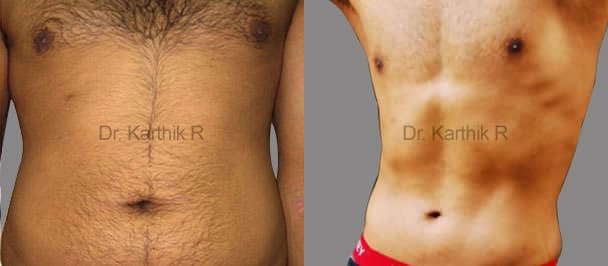 six packs abdominal etching before and after photo by chennai plastic surgery in india
