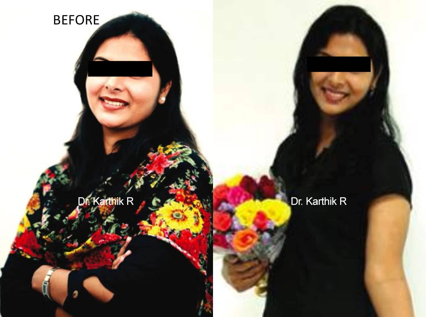 weight loss program before and after photo by chennai plastic surgery in india