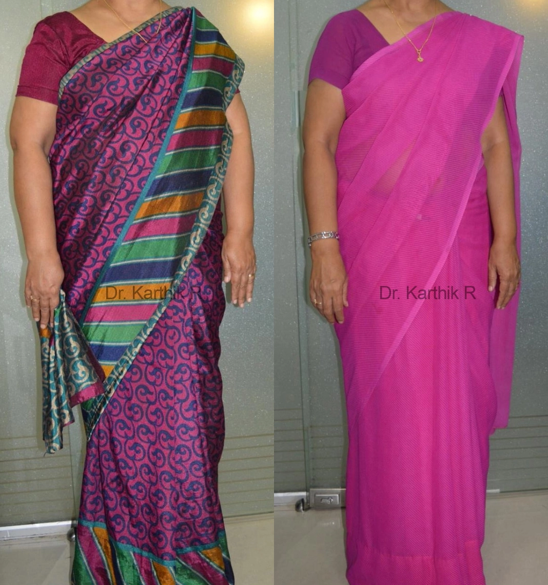 weight loss program before and after photo by chennai plastic surgery in india