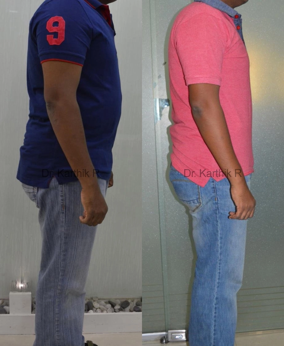 weight loss program before and after photo by chennai plastic surgery in india
