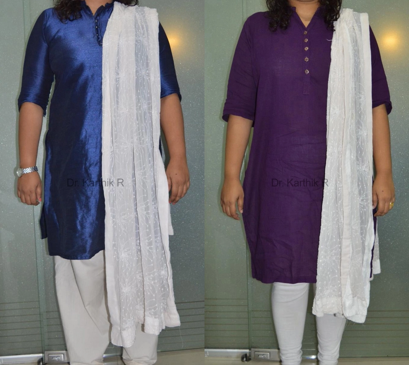 weight loss program before and after photo by chennai plastic surgery in india