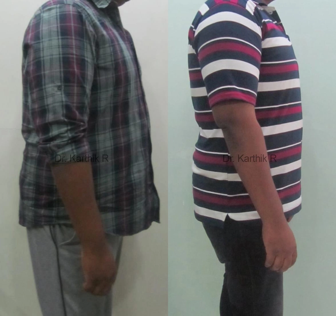 weight loss program before and after photo by chennai plastic surgery in india