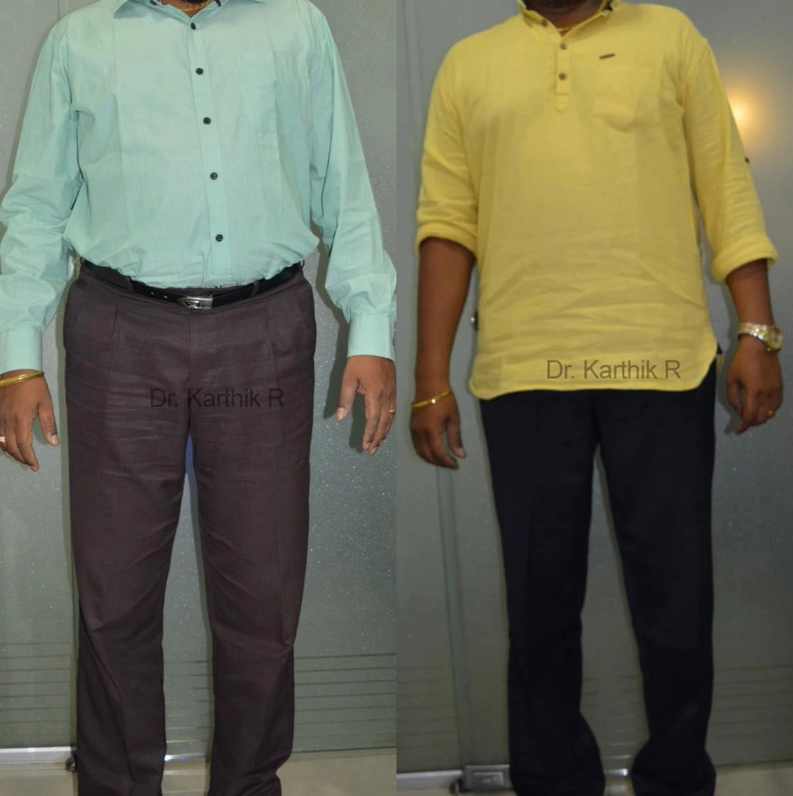 weight loss program before and after photo by chennai plastic surgery in india