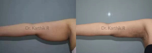 liposuction arms arm tuck before and after photo by chennai plastic surgery in india