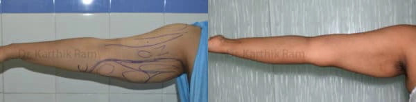 liposuction arms arm tuck before and after photo by chennai plastic surgery in india