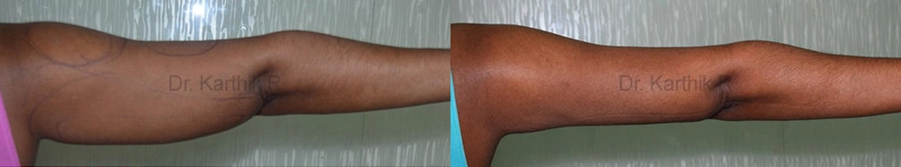 liposuction arms arm tuck before and after photo by chennai plastic surgery in india