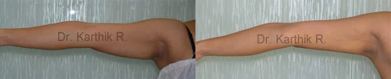 liposuction arms arm tuck before and after photo by chennai plastic surgery in india