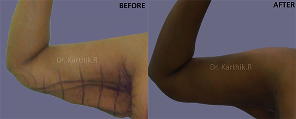 liposuction arms arm tuck before and after photo by chennai plastic surgery in india