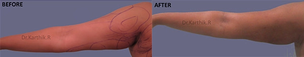 liposuction arms arm tuck before and after photo by chennai plastic surgery in india