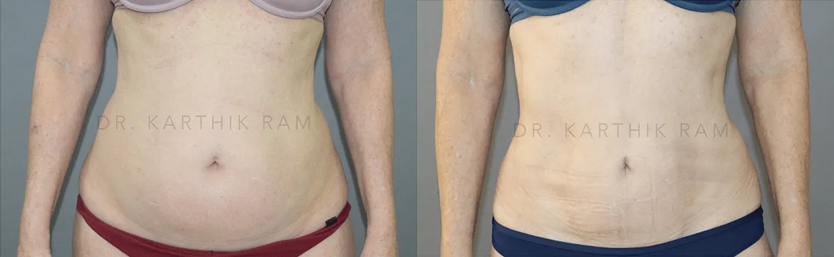 liposuction tummy back before and after photo by chennai plastic surgery in india
