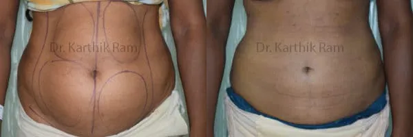 liposuction tummy back before and after photo by chennai plastic surgery in india