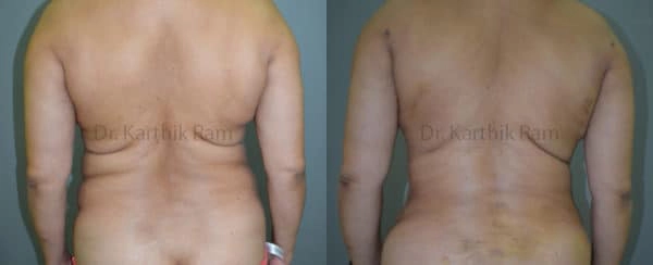 liposuction tummy back before and after photo by chennai plastic surgery in india