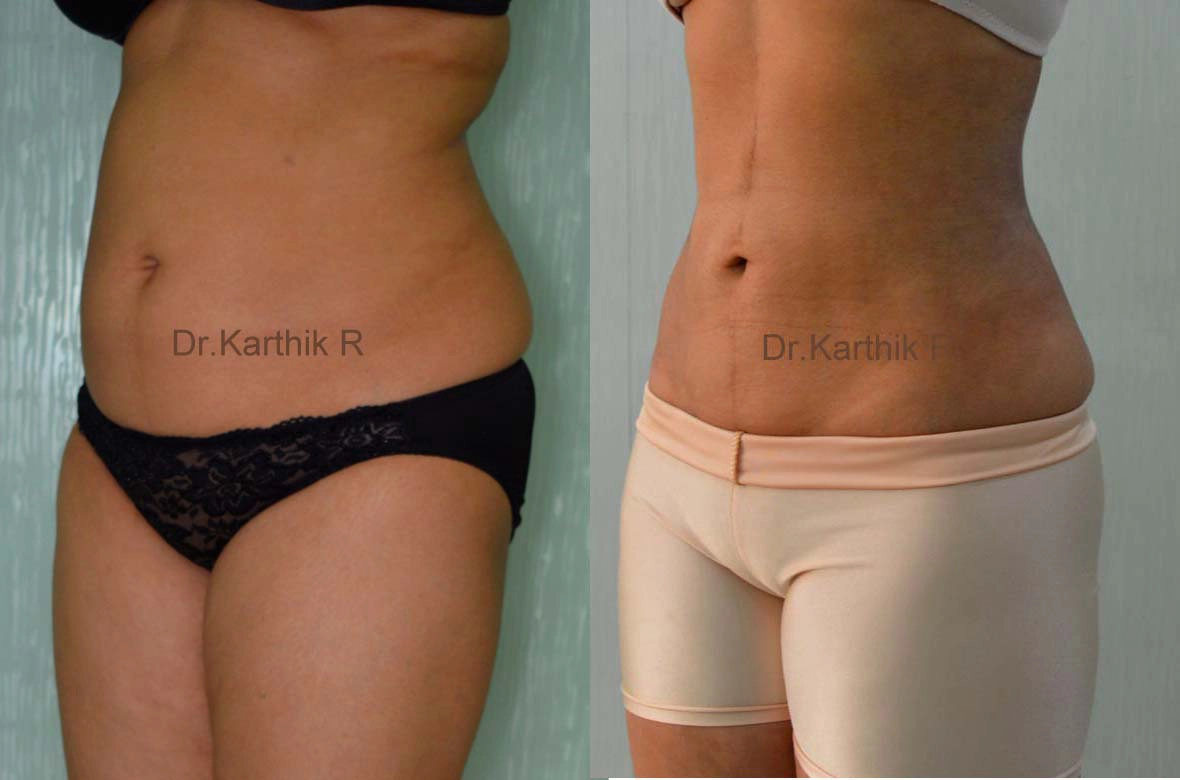 liposuction tummy back before and after photo by chennai plastic surgery in india