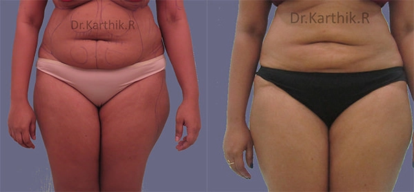liposuction tummy back before and after photo by chennai plastic surgery in india