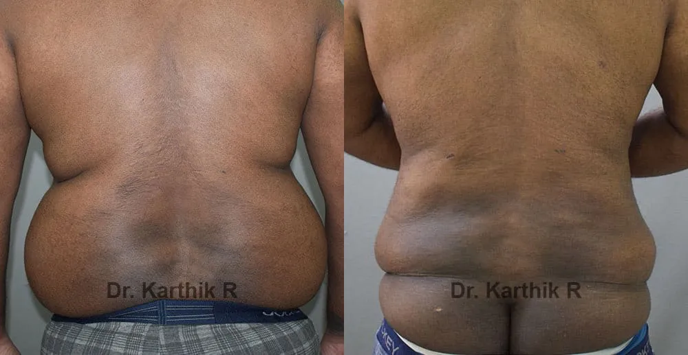 liposuction tummy back before and after photo by chennai plastic surgery in india