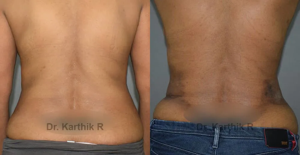 liposuction tummy back before and after photo by chennai plastic surgery in india