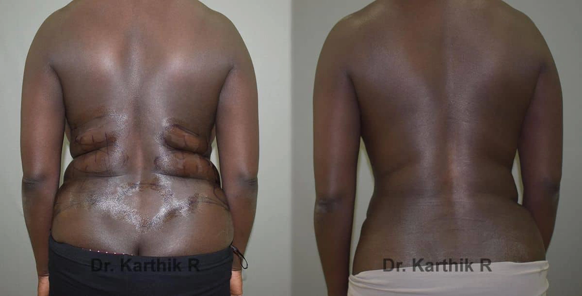 liposuction tummy back before and after photo by chennai plastic surgery in india