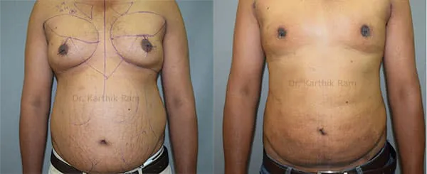 liposuction tummy back before and after photo by chennai plastic surgery in india