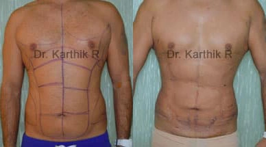 six packs abdominal etching before and after photo by chennai plastic surgery in india