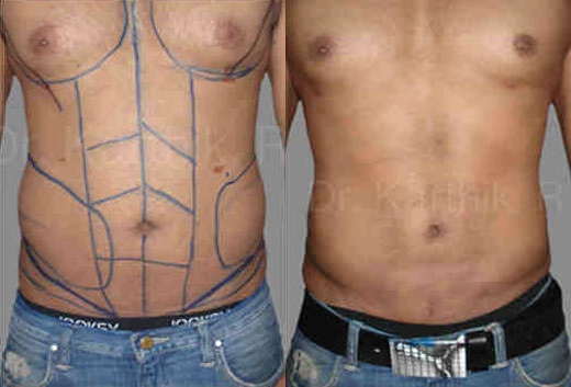 six packs abdominal etching before and after photo by chennai plastic surgery in india