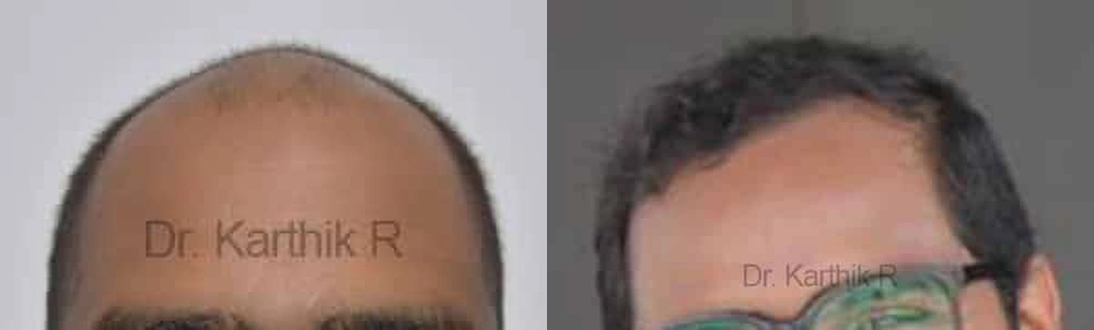 hair transplantation before and after photo by chennai plastic surgery in india