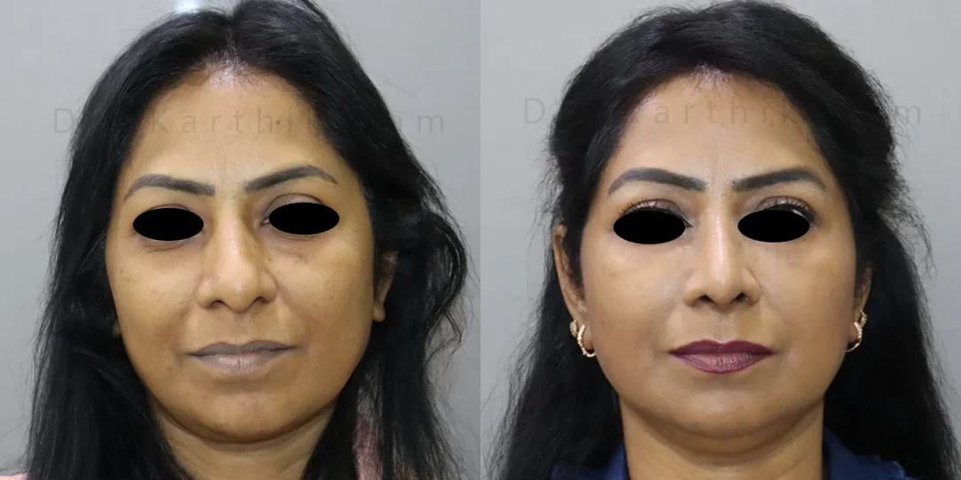 rhinoplasty before and after photo by chennai plastic surgery in india