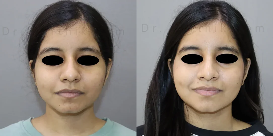 rhinoplasty before and after photo by chennai plastic surgery in india