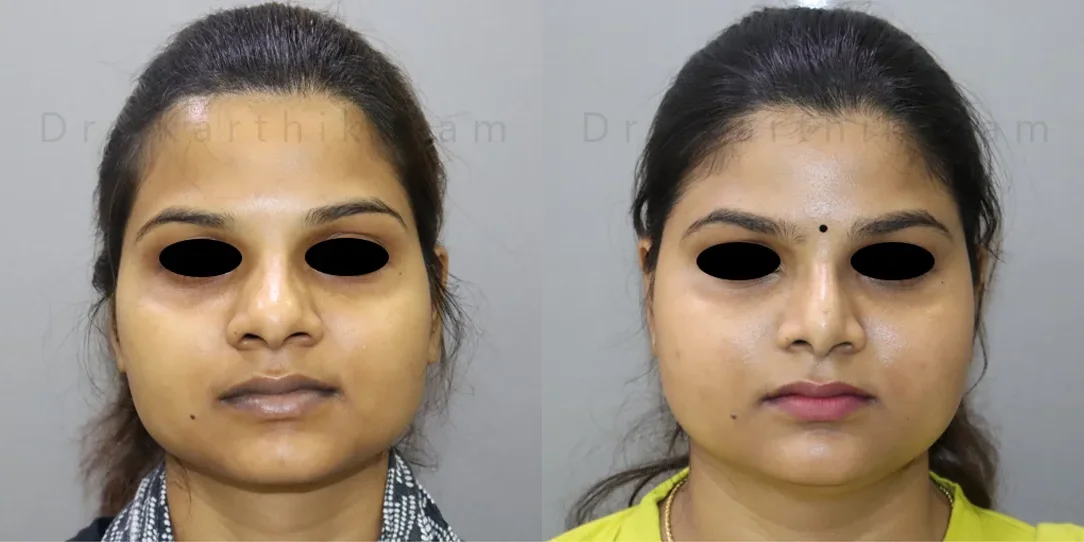 rhinoplasty before and after photo by chennai plastic surgery in india
