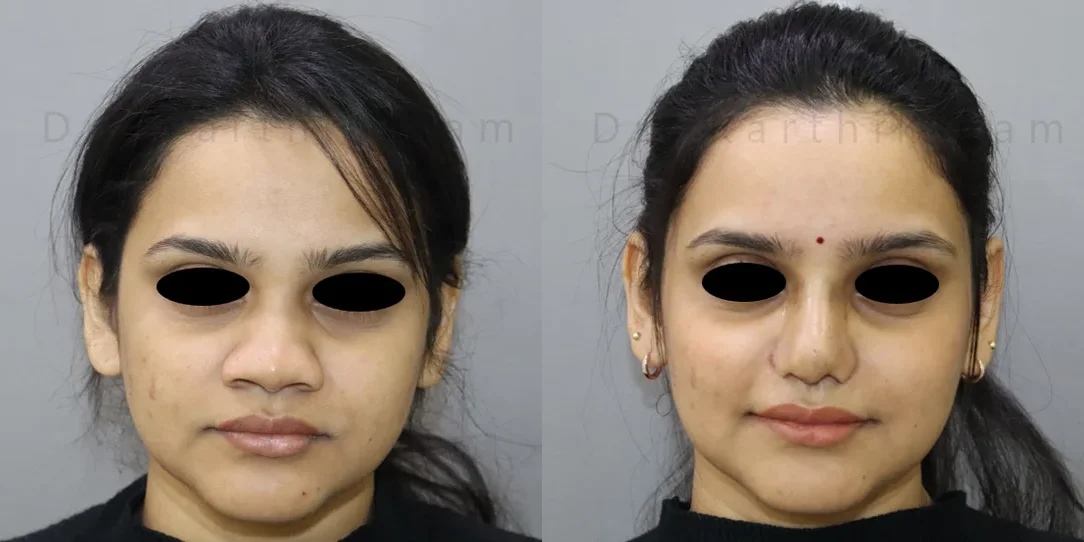 rhinoplasty before and after photo by chennai plastic surgery in india