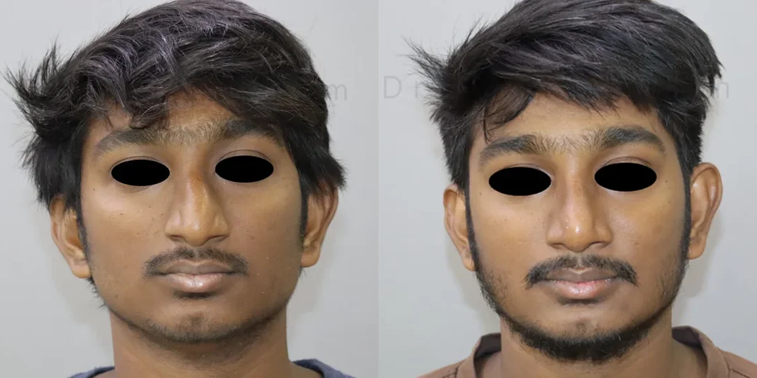 rhinoplasty before and after photo by chennai plastic surgery in india