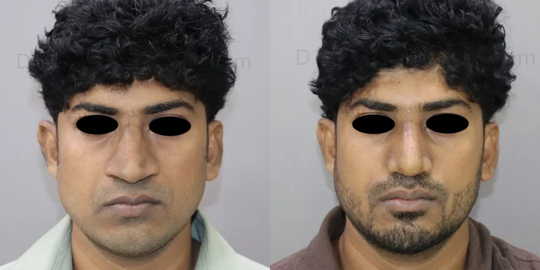 rhinoplasty before and after photo by chennai plastic surgery in india