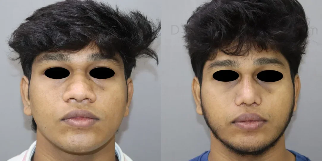 rhinoplasty before and after photo by chennai plastic surgery in india