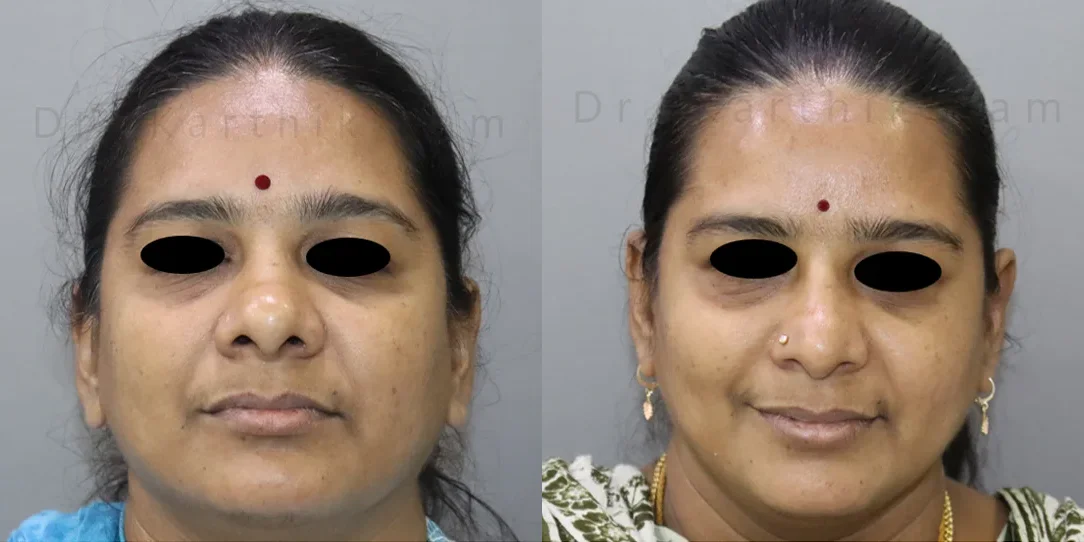 rhinoplasty before and after photo by chennai plastic surgery in india