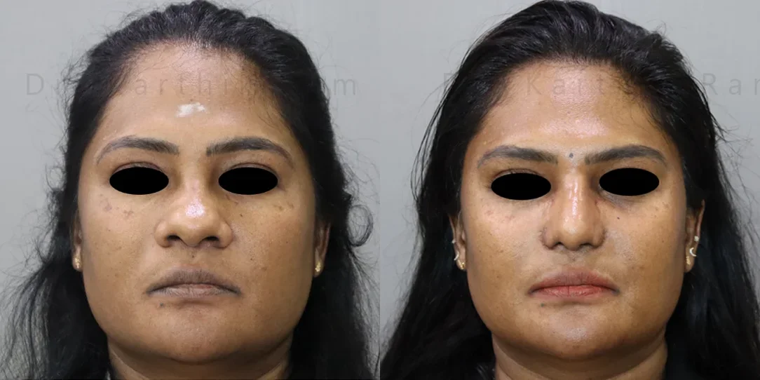 rhinoplasty before and after photo by chennai plastic surgery in india